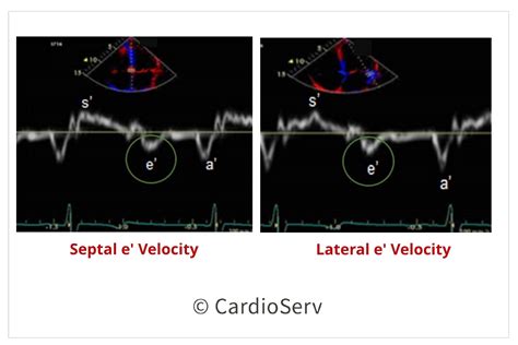 lv e' septal velocity